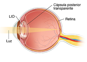 Corte transversal del frente de un ojo en donde se ve la LIO en la cápsula posterior.