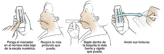 Cinco pasos para usar un medidor de flujo espiratorio máximo.