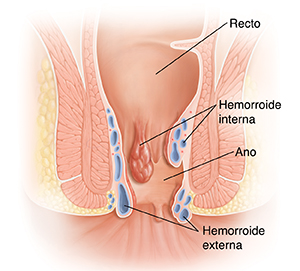 Corte transversal del recto y el ano donde pueden verse hemorroides.