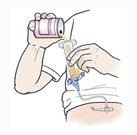 Manos que vierten comida líquida de la lata en una jeringa acoplada al puerto de la sonda de alimentación.