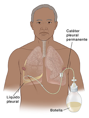 Vista anterior de la parte superior del cuerpo y los pulmones masculinos que muestra un catéter acoplado a un biberón de drenaje e insertado bajo la piel en la cavidad pleural derecha llena de líquido.