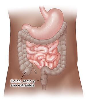 Vista frontal de los intestinos donde se resalta el colon, el recto y el ano para ver la sección a extirpar.