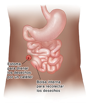 Vista frontal del tracto digestivo inferior donde se observa la extracción del colon y el recto, y la estoma y la bolsa de una ileostomía continente.