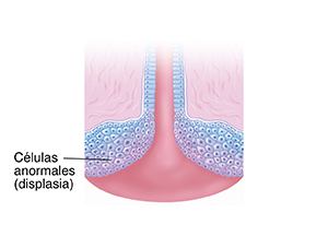 Corte transversal del cuello uterino con displasia, donde se observan células anormales.