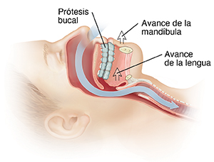 Vista lateral de la cabeza con una flecha que muestra el paso del aire a través de los conductos nasales hacia la tráquea. Las flechas indican el uso de un dispositivo oral para mover la mandíbula inferior hacia adelante.