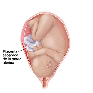 Vista frontal de un feto a término completo en un útero en los huesos pélvicos con la cabeza hacia abajo. Desprendimiento de la placenta de la pared de un útero donde se observa un desgarro de la placenta.