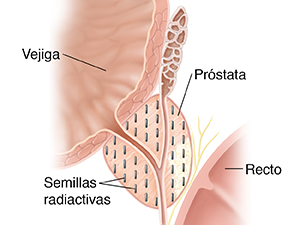 Corte transversal de una próstata donde se ven las semillas radiactivas usadas en la braquirradioterapia intersticial.