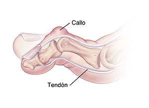 Vista lateral de un dedo del pie donde se observan un callo y un dedo de martillo flexible.