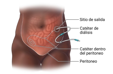 Diálisis peritoneal, en la que se observa el peritoneo, el catéter en el interior del peritoneo y el catéter de diálisis que emerge por el punto de salida en el abdomen.