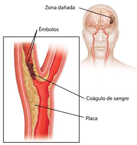 Coágulo sanguíneo que bloquea la arteria carótida y émbolos que se desprenden del coágulo. La imagen insertada muestra el daño cerebral.