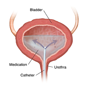 Cross section of bladder showing catheter inserted through ureter, releasing medication.